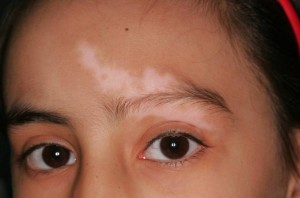 vitiligo