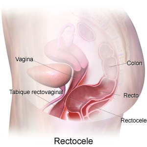 Rectrocele