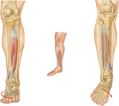 periostitis_tibial