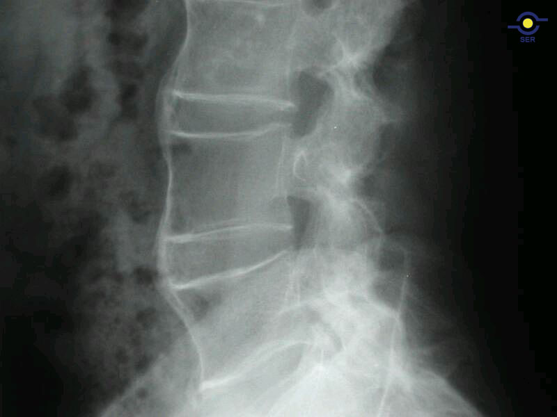 espondilitis_anquilosante