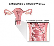 candidiasis-vaginal
