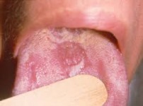 candidiasis_oral