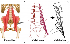 lordosis