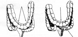 prolapso